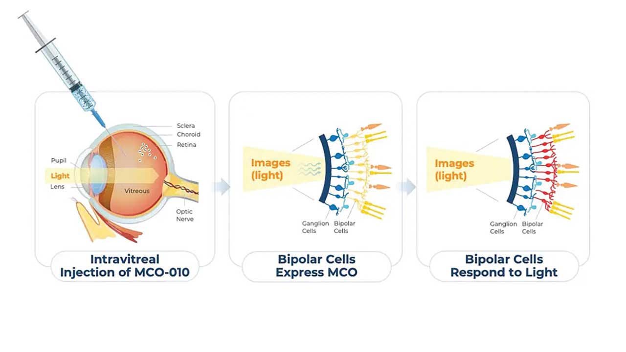 Three panels: an intravitreal injection of MCO-010, bipolar cells expressing the opsin, and bipolar cells responding to light